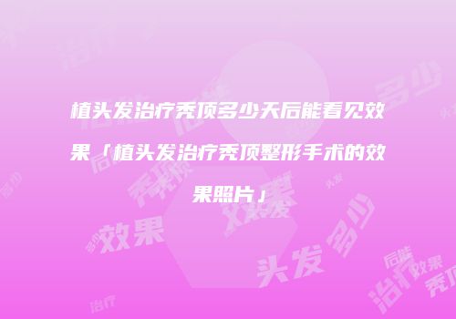 植头发治疗秃顶多少天后能看见效果「植头发治疗秃顶整形手术的效果照片」